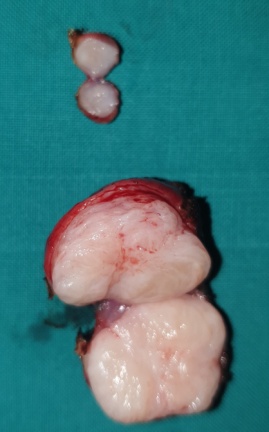 Πλήρης αποδέσμευση αριστερού ουρητήρα (Ευγενική παραχώρηση Dr. V. Penopoulos)