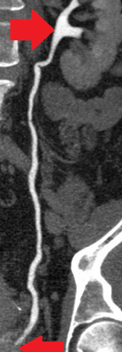 Πλήρης αποδέσμευση αριστερού ουρητήρα (Ευγενική παραχώρηση Dr. V. Penopoulos)