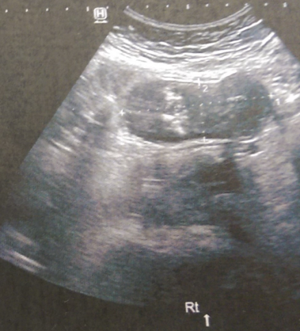 Πυελικό υπερηχογράφημα – Απλή κύστη αριστερής ωοθήκης (Ευγενική παραχώρηση Dr. V. Penopoulos)