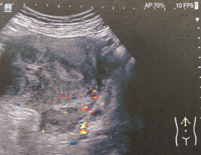 Πυελικό MRI – Νεόπλασμα δεξιάς ωοθήκης (Ευγενική παραχώρηση Dr. V. Penopoulos)