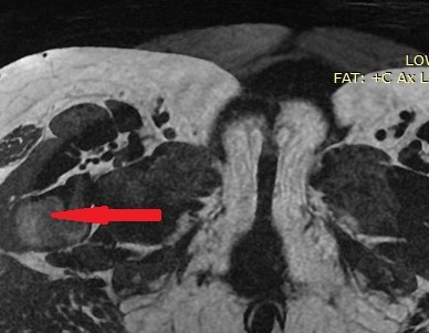 Διάταση αριστερού ουρητήρα λόγω παρουσίας πιθανής εμφύτευσης (Ευγενική παραχώρηση Dr. V. Penopoulos)