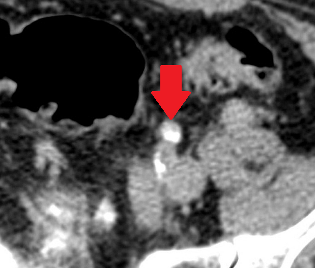 Πράσινο βέλος – Νεόπλασμα Brenner. Μπλε βέλη – Ινομυώματα μήτρας (Ευγενική παραχώρηση Dr. V. Penopoulos)