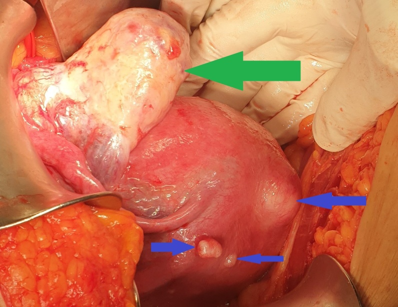 Μακροσκοπική εικόνα δεξιού εξαρτήματος – Καλοήθες νεόπλασμα Brenner (Ευγενική παραχώρηση Dr. V. Penopoulos)