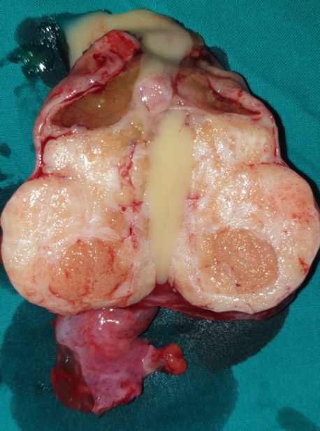 Μακροσκοπική εικόνα εμφύτευσης αριστερού ουρητήρα (Ευγενική παραχώρηση Dr. V. Penopoulos)