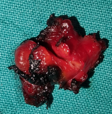 Απλή κύστη αριστερής ωοθήκης (Ευγενική παραχώρηση Dr. V. Penopoulos)