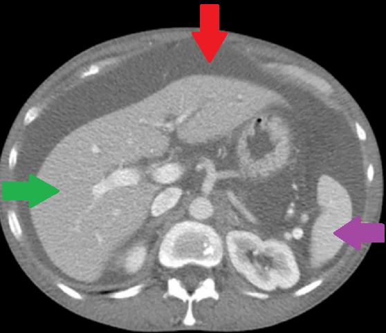 CT κοιλίας. Κόκκινο βέλος – Ασκίτης. Μοβ βέλος – Σπλήνας. Πράσινο βέλος – Ήπαρ (Ευγενική παραχώρηση Dr. V. Penopoulos)