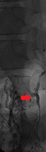 Λεμφαγγειογραφία. Κόκκινο βέλος – Εστία βλάβης (Ευγενική παραχώρηση Dr. V. Penopoulos)