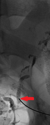 Καθετηριασμός θωρακικού πόρου και ένεση κόλλας (Ευγενική παραχώρηση Dr. V. Penopoulos)