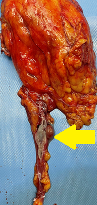 Yellow arrow – Left ureteral metastasis (Courtesy Dr. V. Penopoulos)