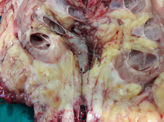 Destroyed left kidney (Courtesy Dr. V. Penopoulos)