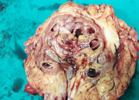 Destroyed left kidney (Courtesy Dr. V. Penopoulos)