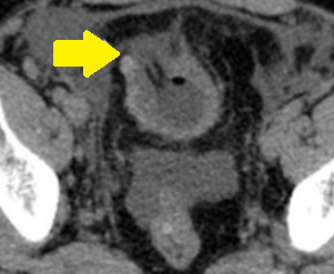 Διεγχειρητική άποψη (μετά από επιδιόρθωση διάτρησης ουροδόχου κύστης) (Ευγενική παραχώρηση Dr. V. Penopoulos)