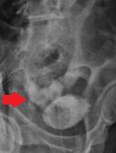 Διεγχειρητική άποψη (μετά από επιδιόρθωση διάτρησης ουροδόχου κύστης) (Ευγενική παραχώρηση Dr. V. Penopoulos)