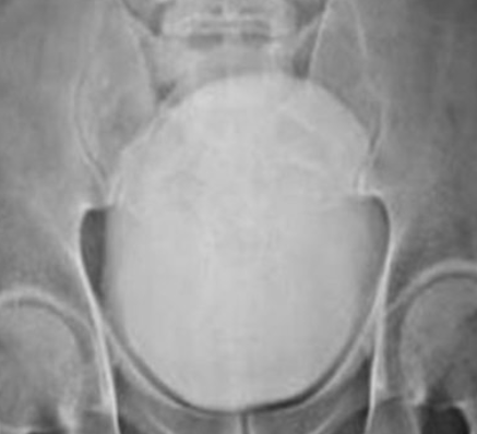 Διεγχειρητική άποψη (μετά από επιδιόρθωση διάτρησης ουροδόχου κύστης) (Ευγενική παραχώρηση Dr. V. Penopoulos)