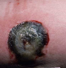 Περιστοματικό γαγγραινώδες πυόδερμα (Ευγενική παραχώρηση Dr. V. Penopoulos)