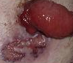 Περιστοματικό γαγγραινώδες πυόδερμα (Ευγενική παραχώρηση Dr. V. Penopoulos)