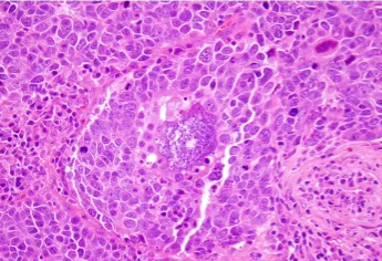 Thymic neuroendocrine carcinoma with pericardial invasion (Courtesy Dr. V. Penopoulos)