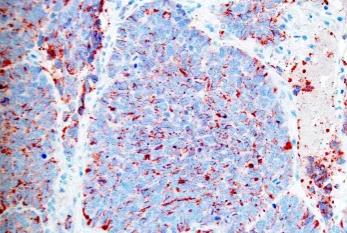Immunohistochemical examination. Strong positivity for chromogranin (Courtesy Dr. V. Penopoulos)