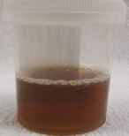 Περιτονιοτομή αριστερού κάτω άκρου (Ευγενική παραχώρηση Dr. V. Penopoulos)