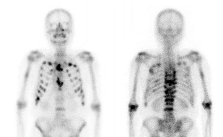 Σπινθηρογράφημα οστών – Παρουσία πολλαπλών οστεολυτικών εστιών (Ευγενική παραχώρηση Dr. V. Penopoulos)