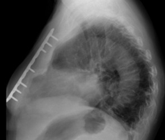 Μετεγχειρητική εικόνα επιδιόρθωσης κατάγματος στέρνου (Ευγενική παραχώρηση Dr. V. Penopoulos)