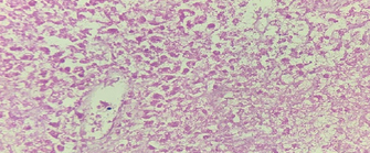 a) Presence of many macrophages containing hemosiderin, cholesterol clefts, mixed with inflammatory cells and cellular debris. b) Presence of fibrocollagenous capsule and intraluminal necrosis (Courtesy Dr. V. Penopoulos)