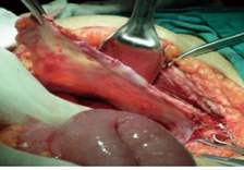 Closed systems for hyperthermic intraperitoneal chemotherapy (Courtesy Dr. V. Penopoulos)