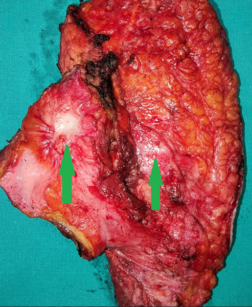 Multiple hepatic metastases — Absolute contraindication for cytoreductive surgery (Courtesy Dr. V. Penopoulos)