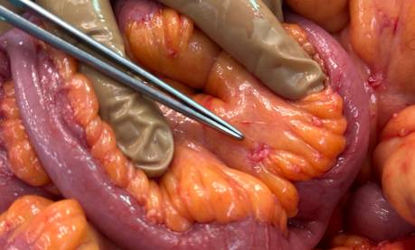 Multiple hepatic metastases — Absolute contraindication for cytoreductive surgery (Courtesy Dr. V. Penopoulos)