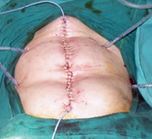 Multiple hepatic metastases — Absolute contraindication for cytoreductive surgery (Courtesy Dr. V. Penopoulos)