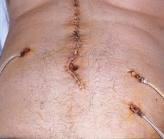 Multiple hepatic metastases — Absolute contraindication for cytoreductive surgery (Courtesy Dr. V. Penopoulos)