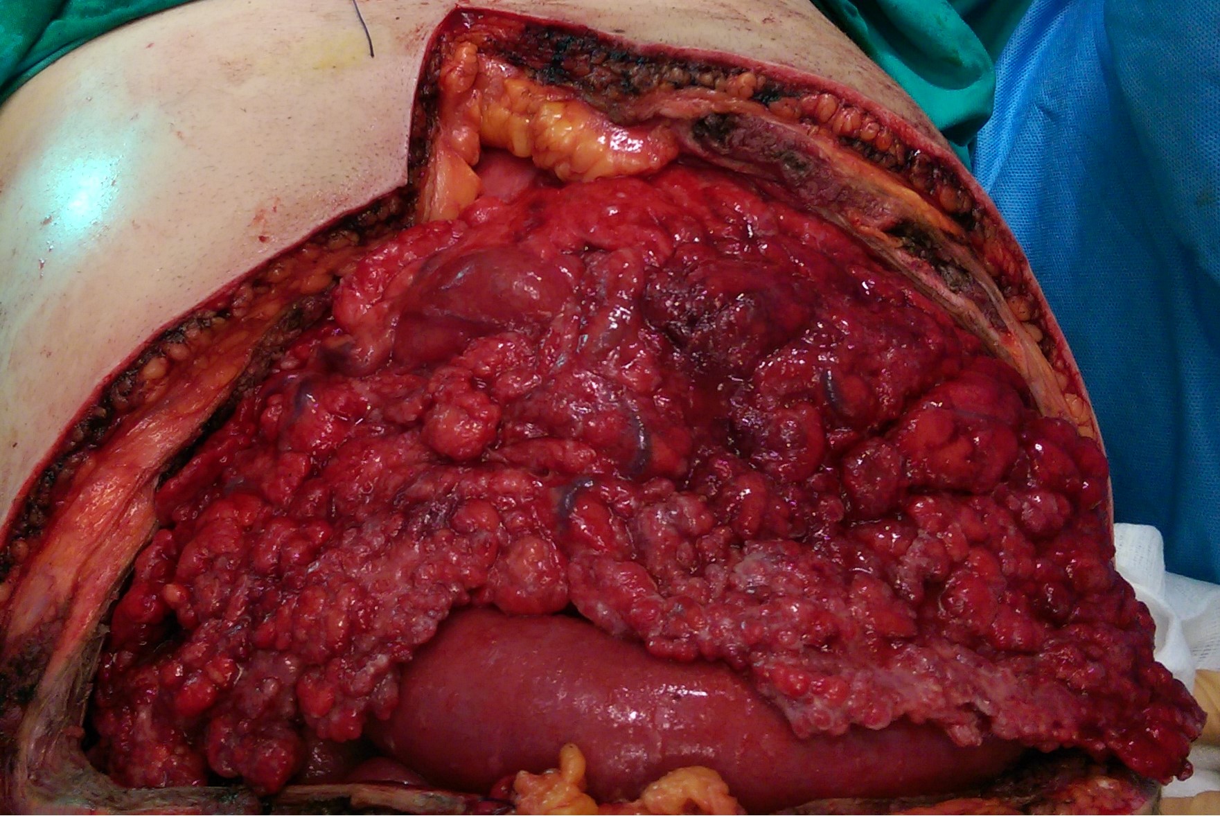 Peritoneal carcinomatosis (gastric ca) (Courtesy Dr. V. Penopoulos)