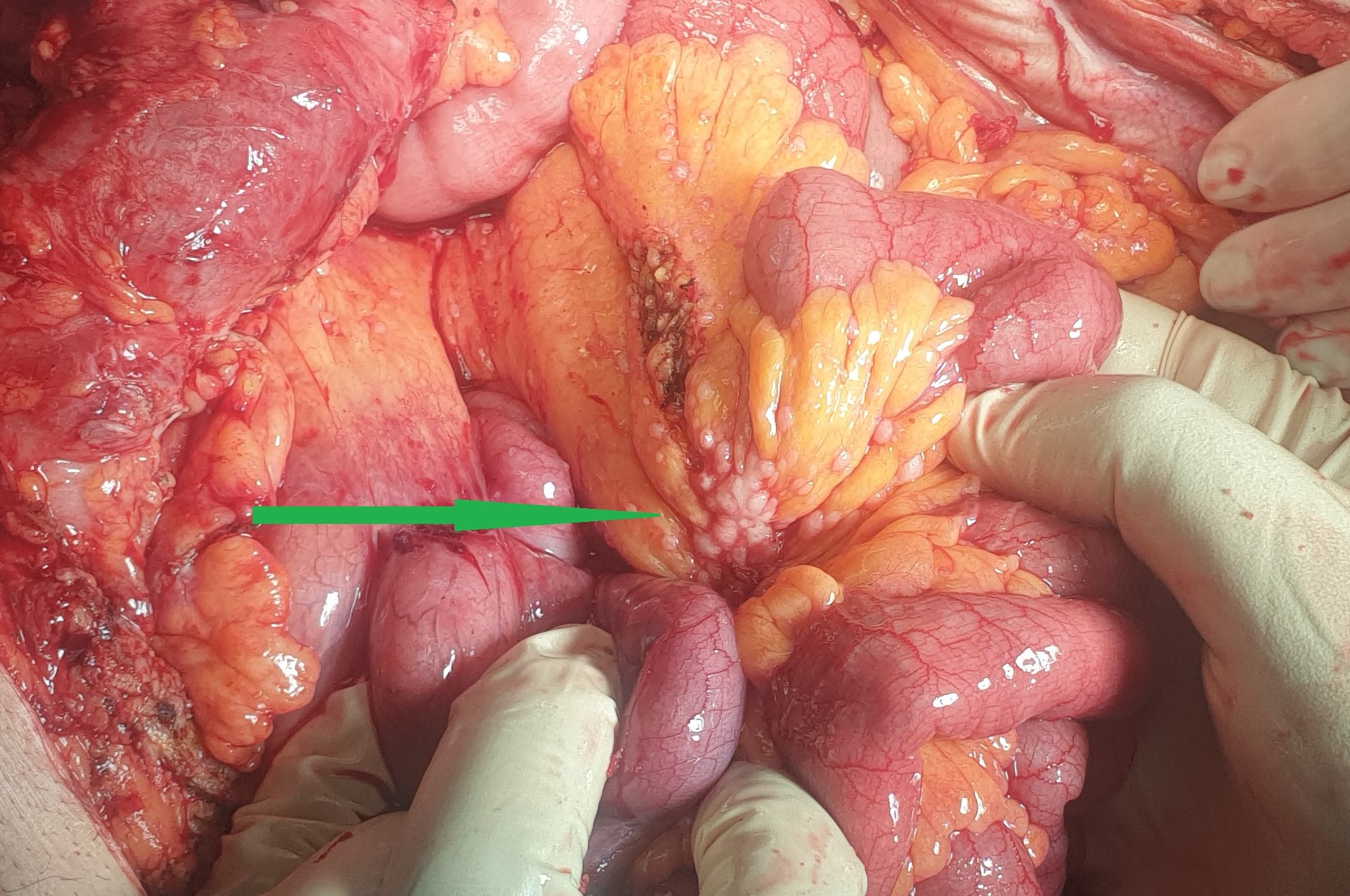 Peritoneal carcinomatosis (colon ca) (Courtesy Dr. V. Penopoulos)