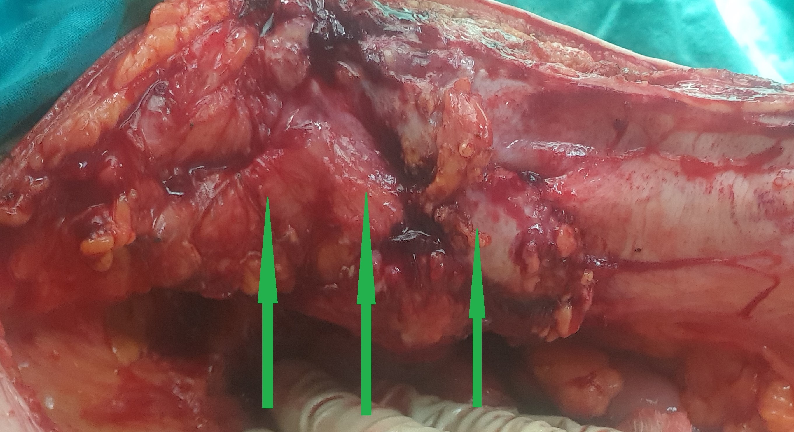 Peritoneal carcinomatosis (small bowel ca) (Courtesy Dr. V. Penopoulos)