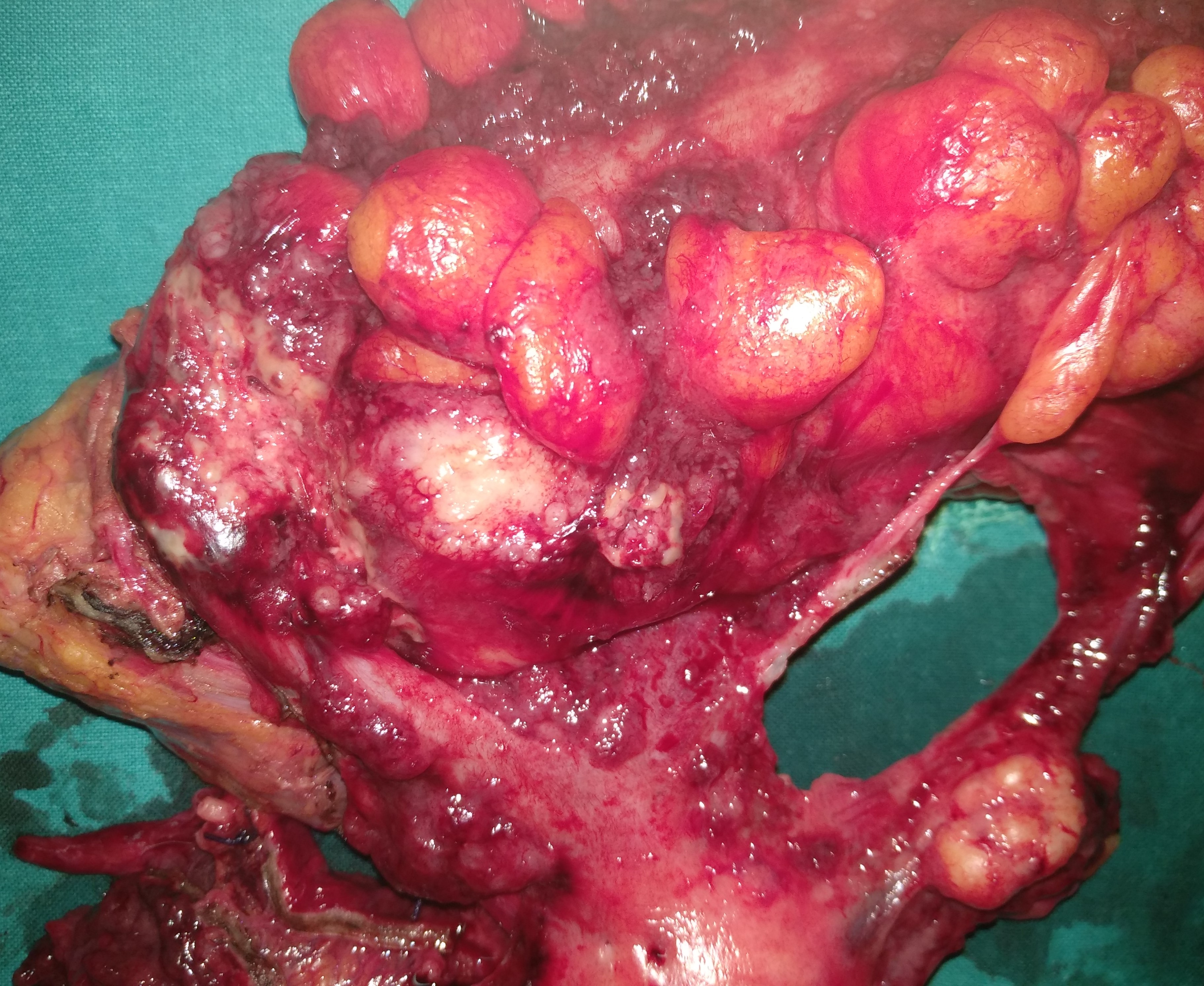 Peritoneal carcinomatosis (appendiceal ca) (Courtesy Dr. V. Penopoulos)