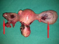 Peritonectomy procedures (Courtesy Dr. V. Penopoulos)