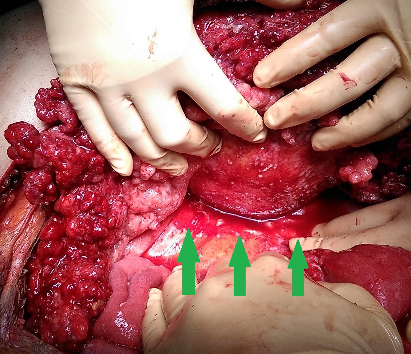 Electrocautery application on implants (Courtesy Dr. V. Penopoulos)