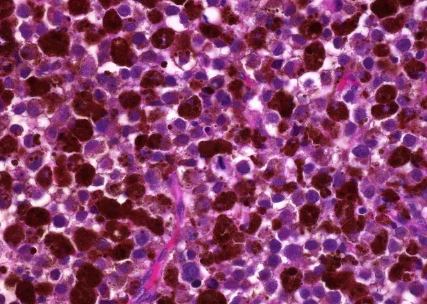 Ανοσοϊστοχημική εξέταση – Θετικότητα για δείκτη HMB45 (Ευγενική παραχώρηση Dr. V. Penopoulos)