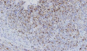 Ανοσοϊστοχημική εξέταση – Θετικότητα για δείκτη HMB45 (Ευγενική παραχώρηση Dr. V. Penopoulos)