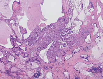 Metastasis of primary pancreatic adenocarcinoma to a small pulmonary artery (Courtesy Dr. V. Penopoulos)