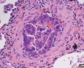Metastasis of primary pancreatic adenocarcinoma to a small pulmonary artery (Courtesy Dr. V. Penopoulos)