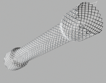 Ενδοσκόπηση μετά από αποβολή stent. Ήπια ανταπόκριση αδενοκαρκινώματος στη χημειοθεραπεία (Ευγενική παραχώρηση Dr. V. Penopoulos)