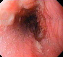 Stent Niti-S (Ευγενική παραχώρηση Dr. V. Penopoulos)