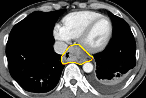 CT θώρακος — Αδενοκαρκίνωμα οισοφάγου με εξωαυλική επέκταση (Ευγενική παραχώρηση Dr. V. Penopoulos)