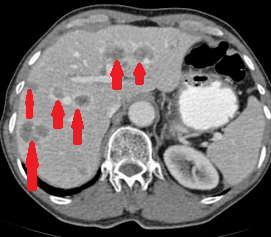 Πολλαπλές ηπατικές μεταστάσεις (Ευγενική παραχώρηση Dr. V. Penopoulos)