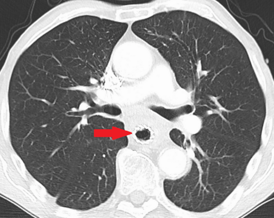 Σωλήνες Souttar (Ευγενική παραχώρηση Dr. V. Penopoulos)