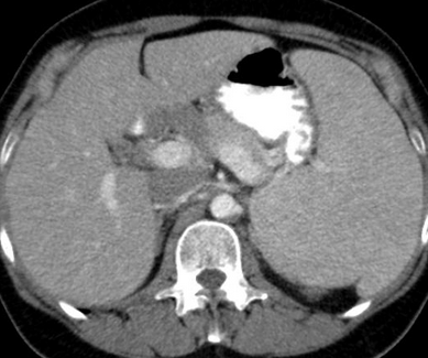 Abdominal CT. Splenomegaly without lymphadenopathy (Courtesy Dr. V. Penopoulos)