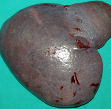 Splenectomy. Macroscopic image of the specimen. The dark red color of the splenic parenchyma is evident (Courtesy Dr. V. Penopoulos)