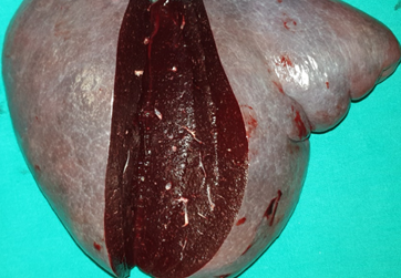 a) Splenic white pulp, enlarged with the presence of a large number of neoplastic cells (small and round). b) Villous lymphocytes, characteristic of SMZL (Courtesy Dr. V. Penopoulos)