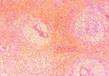 CD20 positivity (Courtesy Dr. V. Penopoulos)